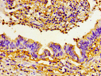 Immunohistochemistry of paraffin-embedded human lung cancer using CSB-PA018830LA01HU at dilution of 1:100