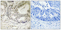 Immunohistochemistry analysis of paraffin-embedded human colon carcinoma tissue using 53BP1 (Phospho-Ser25) antibody. The picture on the right is treated with the synthesized peptide.