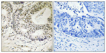 Immunohistochemistry analysis of paraffin-embedded human colon carcinoma tissue using 53BP1 (Phospho-Ser25) antibody. The picture on the right is treated with the synthesized peptide.
