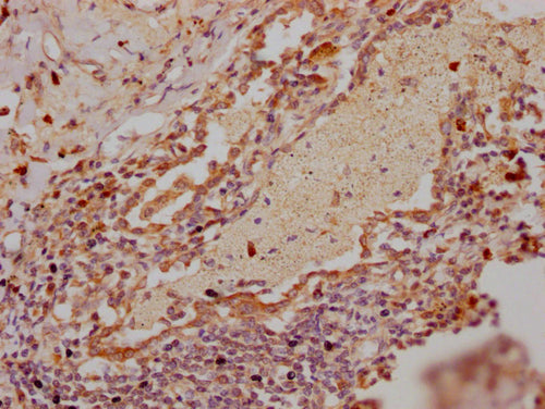 IHC image of CSB-PA019825LA01HU diluted at 1:300 and staining in paraffin-embedded human lung tissue performed on a Leica BondTM system. After dewaxing and hydration, antigen retrieval was mediated by high pressure in a citrate buffer (pH 6.0). Section was blocked with 10% normal goat serum 30min at RT. Then primary antibody (1% BSA) was incubated at 4°C overnight. The primary is detected by a Goat anti-rabbit polymer IgG labeled by HRP and visualized using 0.05% DAB.