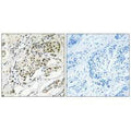 Immunohistochemistry analysis of paraffin-embedded human breast carcinoma tissue using CDYL2 antibody.