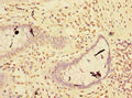 Immunohistochemistry of paraffin-embedded human colon cancer using CSB-PA019860LA01HU at dilution of 1:100