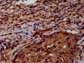 IHC image of CSB-PA019892LA01HU diluted at 1:600 and staining in paraffin-embedded human lung cancer performed on a Leica BondTM system. After dewaxing and hydration, antigen retrieval was mediated by high pressure in a citrate buffer (pH 6.0). Section was blocked with 10% normal goat serum 30min at RT. Then primary antibody (1% BSA) was incubated at 4&deg;C overnight. The primary is detected by a biotinylated secondary antibody and visualized using an HRP conjugated SP system.