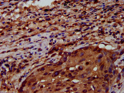 IHC image of CSB-PA019892LA01HU diluted at 1:600 and staining in paraffin-embedded human lung cancer performed on a Leica BondTM system. After dewaxing and hydration, antigen retrieval was mediated by high pressure in a citrate buffer (pH 6.0). Section was blocked with 10% normal goat serum 30min at RT. Then primary antibody (1% BSA) was incubated at 4&deg;C overnight. The primary is detected by a biotinylated secondary antibody and visualized using an HRP conjugated SP system.