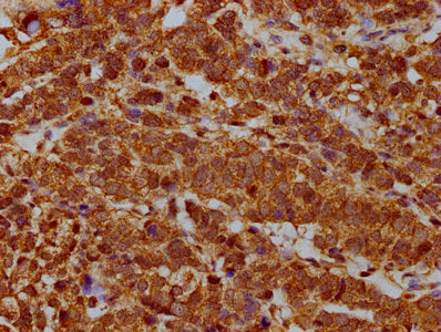 IHC image of CSB-PA020350LA01HU diluted at 1:400 and staining in paraffin-embedded human ovarian cancer performed on a Leica BondTM system. After dewaxing and hydration, antigen retrieval was mediated by high pressure in a citrate buffer (pH 6.0). Section was blocked with 10% normal goat serum 30min at RT. Then primary antibody (1% BSA) was incubated at 4&deg;C overnight. The primary is detected by a biotinylated secondary antibody and visualized using an HRP conjugated SP system.