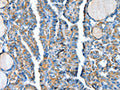 The image on the left is immunohistochemistry of paraffin-embedded Human thyroid cancer tissue using CSB-PA020499(ADCY4 Antibody) at dilution 1/30, on the right is treated with fusion protein. (Original magnification: ×200)