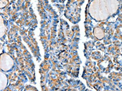 The image on the left is immunohistochemistry of paraffin-embedded Human thyroid cancer tissue using CSB-PA020499(ADCY4 Antibody) at dilution 1/30, on the right is treated with fusion protein. (Original magnification: ×200)