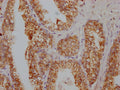 IHC image of CSB-PA020626HA01HU diluted at 1:100 and staining in paraffin-embedded human prostate cancer performed on a Leica BondTM system. After dewaxing and hydration, antigen retrieval was mediated by high pressure in a citrate buffer (pH 6.0). Section was blocked with 10% normal goat serum 30min at RT. Then primary antibody (1% BSA) was incubated at 4°C overnight. The primary is detected by a Goat anti-rabbit IgG labeled by HRP and visualized using 0.05% DAB.
