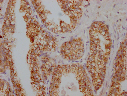IHC image of CSB-PA020626HA01HU diluted at 1:100 and staining in paraffin-embedded human prostate cancer performed on a Leica BondTM system. After dewaxing and hydration, antigen retrieval was mediated by high pressure in a citrate buffer (pH 6.0). Section was blocked with 10% normal goat serum 30min at RT. Then primary antibody (1% BSA) was incubated at 4°C overnight. The primary is detected by a Goat anti-rabbit IgG labeled by HRP and visualized using 0.05% DAB.