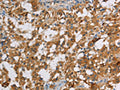 The image on the left is immunohistochemistry of paraffin-embedded Human thyroid cancer tissue using CSB-PA020742(DBH Antibody) at dilution 1/70, on the right is treated with fusion protein. (Original magnification: ×200)
