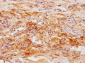 IHC image of CSB-PA021175NA01HU diluted at 1:100 and staining in paraffin-embedded human lung cancer performed on a Leica BondTM system. After dewaxing and hydration, antigen retrieval was mediated by high pressure in a citrate buffer (pH 6.0). Section was blocked with 10% normal goat serum 30min at RT. Then primary antibody (1% BSA) was incubated at 4°C overnight. The primary is detected by a Goat anti-rabbit polymer IgG labeled by HRP and visualized using 0.05% DAB.