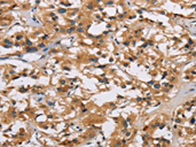 The image on the left is immunohistochemistry of paraffin-embedded Human thyroid cancer tissue using CSB-PA021391(IL19 Antibody) at dilution 1/40, on the right is treated with synthetic peptide. (Original magnification: ×200)