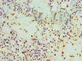 Immunohistochemistry of paraffin-embedded human breast cancer using CSB-PA021912DSR1HU at dilution of 1:100