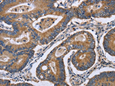 The image is immunohistochemistry of paraffin-embedded Human colon cancer tissue using CSB-PA022040(GABPB2 Antibody) at dilution 1/30. (Original magnification: ×200)