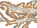 The image on the left is immunohistochemistry of paraffin-embedded Human thyroid cancer tissue using CSB-PA022239(RRAGA Antibody) at dilution 1/30, on the right is treated with fusion protein. (Original magnification: ×200)
