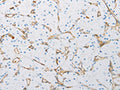 The image on the left is immunohistochemistry of paraffin-embedded Human renal cancer tissue using CSB-PA022257(PECAM1 Antibody) at dilution 1/25, on the right is treated with synthetic peptide. (Original magnification: ×200)