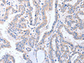 The image on the left is immunohistochemistry of paraffin-embedded Human thyroid cancer tissue using CSB-PA022273(ACTL8 Antibody) at dilution 1/15, on the right is treated with fusion protein. (Original magnification: ×200)