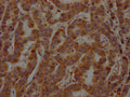 IHC image of CSB-PA022650LA11HU diluted at 1:200 and staining in paraffin-embedded human breast cancer performed on a Leica BondTM system. After dewaxing and hydration, antigen retrieval was mediated by high pressure in a citrate buffer (pH 6.0). Section was blocked with 10% normal goat serum 30min at RT. Then primary antibody (1% BSA) was incubated at 4°C overnight. The primary is detected by a Goat anti-rabbit polymer IgG labeled by HRP and visualized using 0.05% DAB.