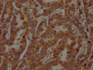 IHC image of CSB-PA022650LA11HU diluted at 1:200 and staining in paraffin-embedded human breast cancer performed on a Leica BondTM system. After dewaxing and hydration, antigen retrieval was mediated by high pressure in a citrate buffer (pH 6.0). Section was blocked with 10% normal goat serum 30min at RT. Then primary antibody (1% BSA) was incubated at 4°C overnight. The primary is detected by a Goat anti-rabbit polymer IgG labeled by HRP and visualized using 0.05% DAB.