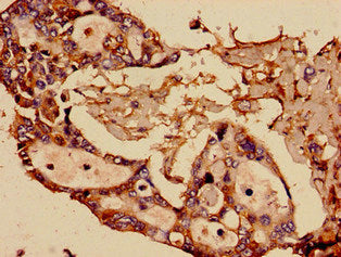 Immunohistochemistry analysis of human pancreatic cancer using CSB-PA022723OJ01HU at dilution of 1:100