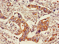 Immunohistochemistry of paraffin-embedded human pancreatic cancer using CSB-PA022816LA01HU at dilution of 1:100