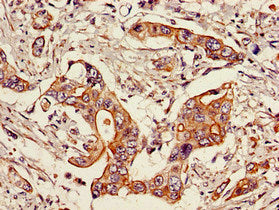 Immunohistochemistry of paraffin-embedded human pancreatic cancer using CSB-PA022816LA01HU at dilution of 1:100