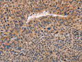 The image on the left is immunohistochemistry of paraffin-embedded Human liver cancer tissue using CSB-PA023292(ADAMDEC1 Antibody) at dilution 1/20, on the right is treated with fusion protein. (Original magnification: ×200)