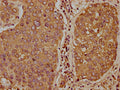 IHC image of CSB-PA023314LA01HU diluted at 1:400 and staining in paraffin-embedded human liver cancer performed on a Leica BondTM system. After dewaxing and hydration, antigen retrieval was mediated by high pressure in a citrate buffer (pH 6.0). Section was blocked with 10% normal goat serum 30min at RT. Then primary antibody (1% BSA) was incubated at 4&deg;C overnight. The primary is detected by a biotinylated secondary antibody and visualized using an HRP conjugated SP system.