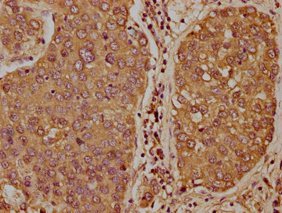 IHC image of CSB-PA023314LA01HU diluted at 1:400 and staining in paraffin-embedded human liver cancer performed on a Leica BondTM system. After dewaxing and hydration, antigen retrieval was mediated by high pressure in a citrate buffer (pH 6.0). Section was blocked with 10% normal goat serum 30min at RT. Then primary antibody (1% BSA) was incubated at 4&deg;C overnight. The primary is detected by a biotinylated secondary antibody and visualized using an HRP conjugated SP system.