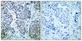 Immunohistochemical analysis of paraffin-embedded human breast carcinoma tissue using SEK1/MKK4(Phospho-Thr261) Antibody(left) or the same antibody preincubated with blocking peptide(right).