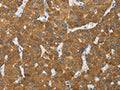 The image on the left is immunohistochemistry of paraffin-embedded Human liver cancer tissue using CSB-PA023517(ENTPD5 Antibody) at dilution 1/20, on the right is treated with fusion protein. (Original magnification: ×200)