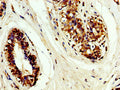 IHC image of CSB-PA023562LA01HU diluted at 1:200 and staining in paraffin-embedded human breast cancer performed on a Leica BondTM system. After dewaxing and hydration, antigen retrieval was mediated by high pressure in a citrate buffer (pH 6.0). Section was blocked with 10% normal goat serum 30min at RT. Then primary antibody (1% BSA) was incubated at 4&deg;C overnight. The primary is detected by a biotinylated secondary antibody and visualized using an HRP conjugated SP system.