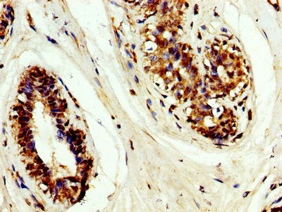IHC image of CSB-PA023562LA01HU diluted at 1:200 and staining in paraffin-embedded human breast cancer performed on a Leica BondTM system. After dewaxing and hydration, antigen retrieval was mediated by high pressure in a citrate buffer (pH 6.0). Section was blocked with 10% normal goat serum 30min at RT. Then primary antibody (1% BSA) was incubated at 4&deg;C overnight. The primary is detected by a biotinylated secondary antibody and visualized using an HRP conjugated SP system.