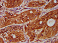 IHC image of CSB-PA023975LA01HU diluted at 1:500 and staining in paraffin-embedded human cervical cancer performed on a Leica BondTM system. After dewaxing and hydration, antigen retrieval was mediated by high pressure in a citrate buffer (pH 6.0). Section was blocked with 10% normal goat serum 30min at RT. Then primary antibody (1% BSA) was incubated at 4&deg;C overnight. The primary is detected by a biotinylated secondary antibody and visualized using an HRP conjugated SP system.