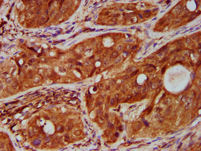 IHC image of CSB-PA023975LA01HU diluted at 1:500 and staining in paraffin-embedded human cervical cancer performed on a Leica BondTM system. After dewaxing and hydration, antigen retrieval was mediated by high pressure in a citrate buffer (pH 6.0). Section was blocked with 10% normal goat serum 30min at RT. Then primary antibody (1% BSA) was incubated at 4&deg;C overnight. The primary is detected by a biotinylated secondary antibody and visualized using an HRP conjugated SP system.