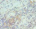 Immunohistochemistry of paraffin-embedded human breast cancer using CSB-PA023989ESR2HU at dilution of 1:100