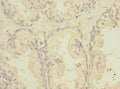 Immunohistochemistry of paraffin-embedded human prostate cancer using CSB-PA023992ESR2HU at dilution of 1:100