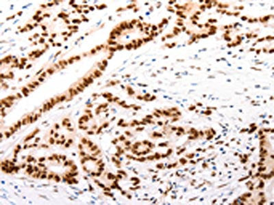 The image on the left is immunohistochemistry of paraffin-embedded Human colon cancer tissue using CSB-PA024373(CASP9 (active) Antibody) at dilution 1/80, on the right is treated with synthetic peptide. (Original magnification: ×200)