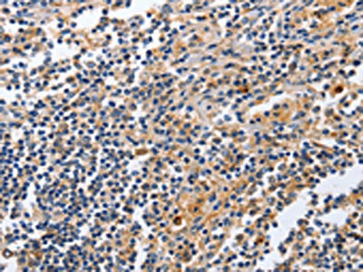 The image on the left is immunohistochemistry of paraffin-embedded Human tonsil tissue using CSB-PA024849(MSH3 Antibody) at dilution 1/20, on the right is treated with fusion protein. (Original magnification: ×200)