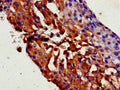 Immunohistochemistry of paraffin-embedded human breast cancer using CSB-PA025075LA01HU at dilution of 1:100