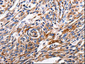 The image is immunohistochemistry of paraffin-embedded Human esophagus cancer tissue using CSB-PA025395(ACE2 Antibody) at dilution 1/200. (Original magnification: ×200)