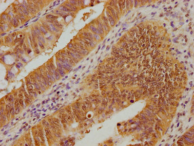 IHC image of CSB-PA025468OA01HU diluted at 1:100 and staining in paraffin-embedded human colon cancer performed on a Leica BondTM system. After dewaxing and hydration, antigen retrieval was mediated by high pressure in a citrate buffer (pH 6.0). Section was blocked with 10% normal goat serum 30min at RT. Then primary antibody (1% BSA) was incubated at 4°C overnight. The primary is detected by a biotinylated secondary antibody and visualized using an HRP conjugated SP system.