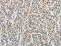 The image on the left is immunohistochemistry of paraffin-embedded Human esophagus cancer tissue using CSB-PA025575(EDA2R Antibody) at dilution 1/50, on the right is treated with fusion protein. (Original magnification: ×200)