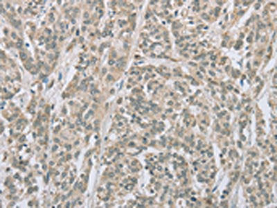 The image on the left is immunohistochemistry of paraffin-embedded Human esophagus cancer tissue using CSB-PA025575(EDA2R Antibody) at dilution 1/50, on the right is treated with fusion protein. (Original magnification: ×200)