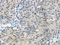 The image on the left is immunohistochemistry of paraffin-embedded Human breast cancer tissue using CSB-PA025580(GLP2R Antibody) at dilution 1/30, on the right is treated with fusion protein. (Original magnification: ×200)