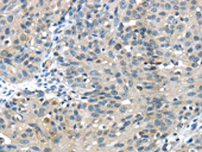 The image on the left is immunohistochemistry of paraffin-embedded Human breast cancer tissue using CSB-PA025580(GLP2R Antibody) at dilution 1/30, on the right is treated with fusion protein. (Original magnification: ×200)