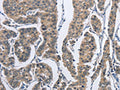 The image on the left is immunohistochemistry of paraffin-embedded Human breast cancer tissue using CSB-PA025645(DSG2 Antibody) at dilution 1/50, on the right is treated with fusion protein. (Original magnification: ×200)