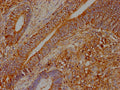 IHC image of CSB-PA025965LA01HU diluted at 1:400 and staining in paraffin-embedded human colon cancer performed on a Leica BondTM system. After dewaxing and hydration, antigen retrieval was mediated by high pressure in a citrate buffer (pH 6.0). Section was blocked with 10% normal goat serum 30min at RT. Then primary antibody (1% BSA) was incubated at 4°C overnight. The primary is detected by a biotinylated secondary antibody and visualized using an HRP conjugated SP system.