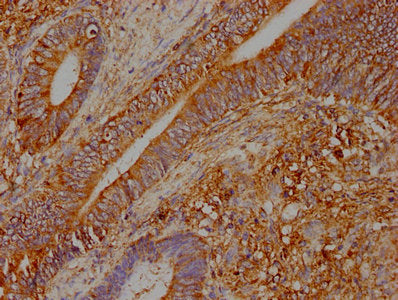 IHC image of CSB-PA025965LA01HU diluted at 1:400 and staining in paraffin-embedded human colon cancer performed on a Leica BondTM system. After dewaxing and hydration, antigen retrieval was mediated by high pressure in a citrate buffer (pH 6.0). Section was blocked with 10% normal goat serum 30min at RT. Then primary antibody (1% BSA) was incubated at 4°C overnight. The primary is detected by a biotinylated secondary antibody and visualized using an HRP conjugated SP system.