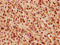 IHC image of CSB-PA026123LA01HU diluted at 1:200 and staining in paraffin-embedded human glioma performed on a Leica BondTM system. After dewaxing and hydration, antigen retrieval was mediated by high pressure in a citrate buffer (pH 6.0). Section was blocked with 10% normal goat serum 30min at RT. Then primary antibody (1% BSA) was incubated at 4&deg;C overnight. The primary is detected by a biotinylated secondary antibody and visualized using an HRP conjugated SP system.